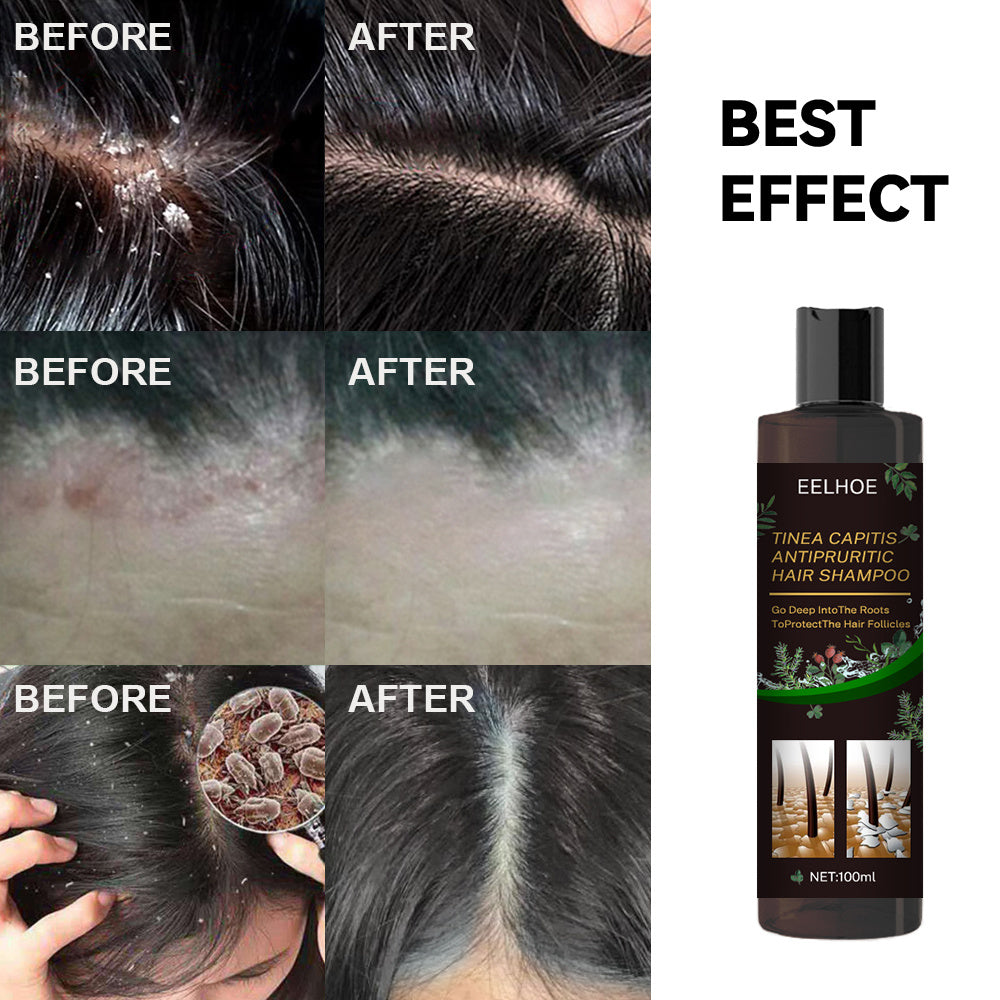 Anti-Dandruff Shampoo,Shampoo For Scalp Prone To Folliculitis, Dermatitis, Dandruff, Itchy And Flaky Scalp,Treats Dandruff And Seborrheic Dermatitis,Anti-Itch Shampoo