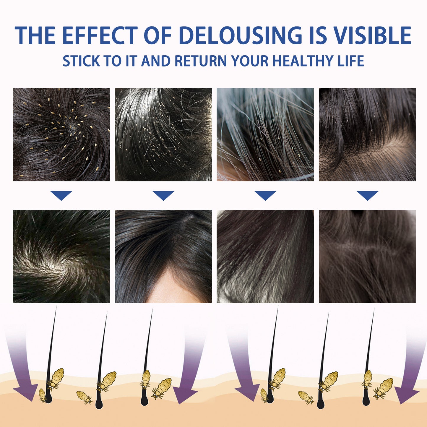 Head Lice Removal Spray